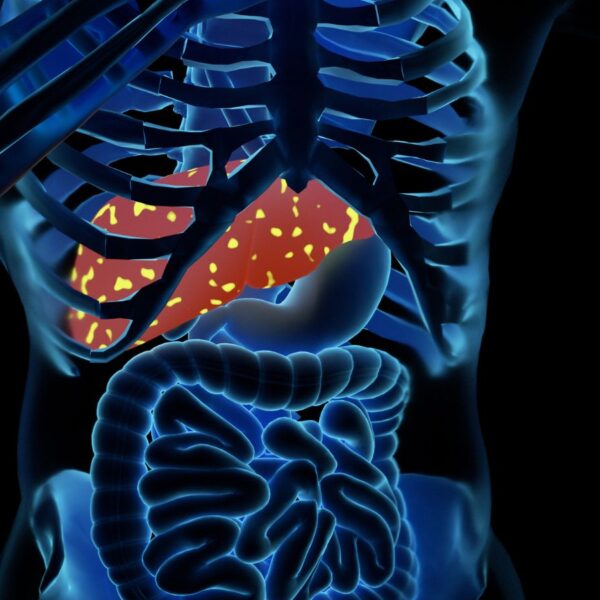 fatty liver