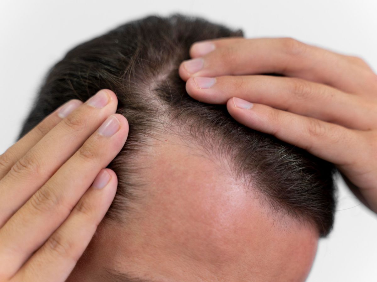 SCALP PSORIASIS TREATMENT